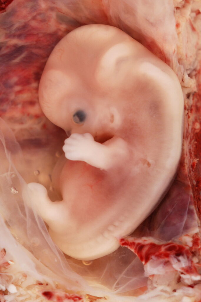 1280px-9-Week_Human_Embryo_from_Ectopic_Pregnancy